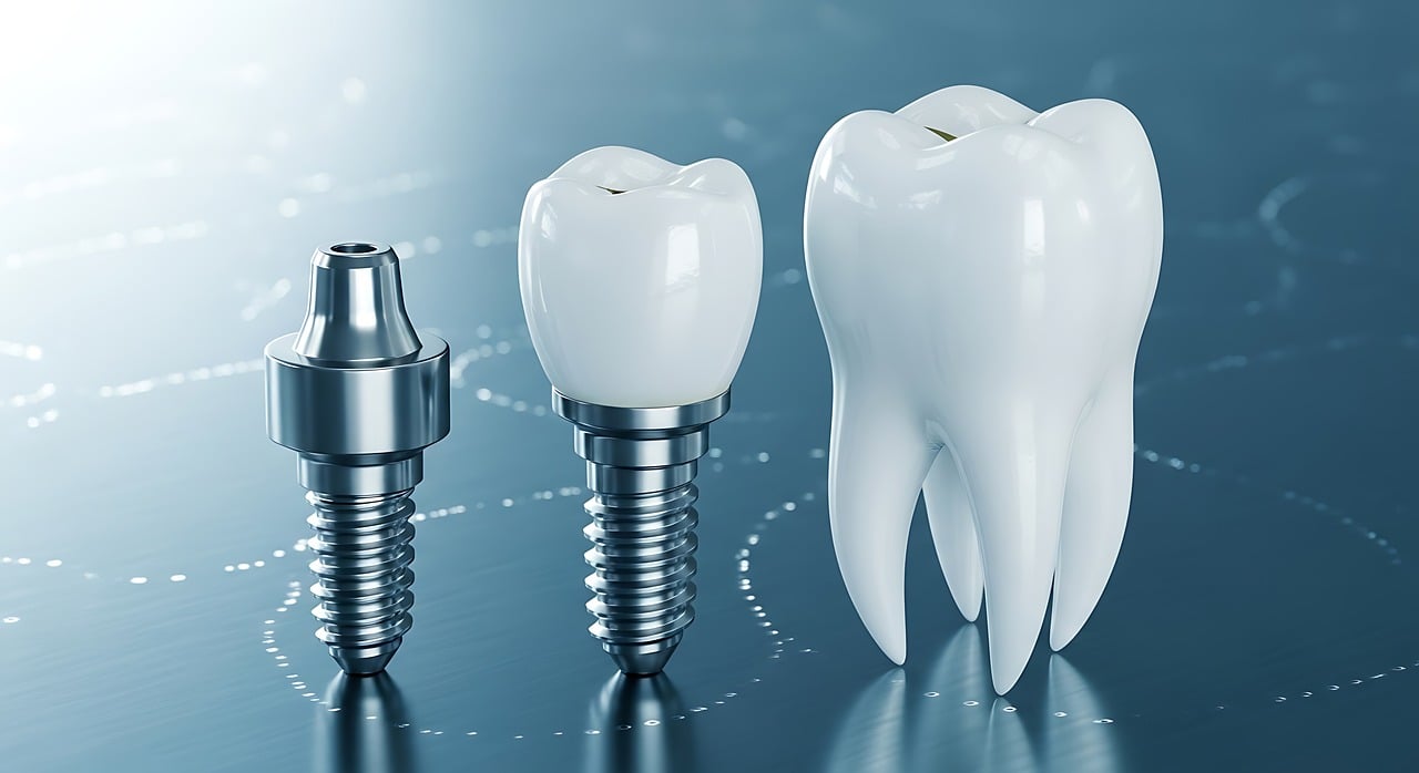 Dental Implants in Whittier